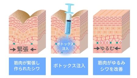 ボトックスでシワが改善される仕組み💡