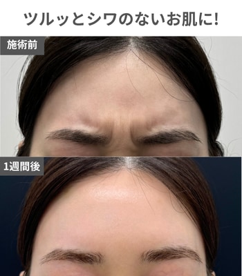 第1位🥇おでこ・眉間の表情ジワ