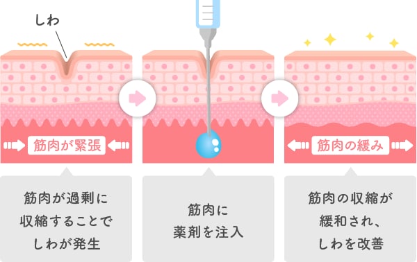 ボトックス（しわ取り注射）でシワが改善される仕組み💡