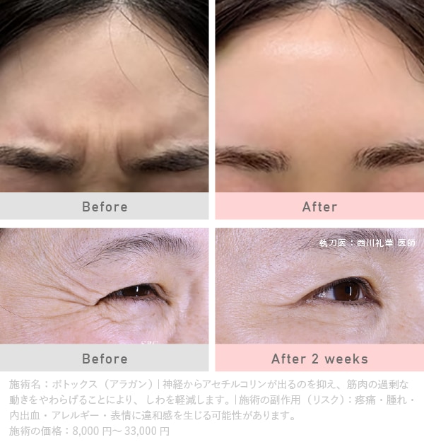 第1位🥇<br />
おでこ・眉間・目尻の「シワ取り」