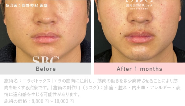 第2位🥈エラボトックス（小顔・食いしばり）