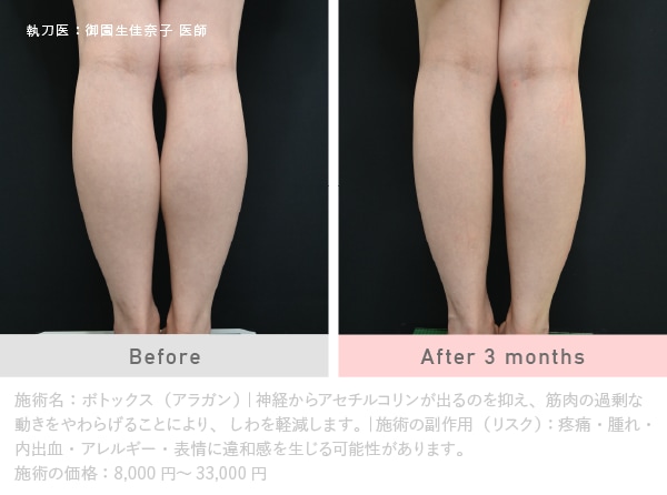 第3位🥉肩こり・脇汗・脚痩せボトックス