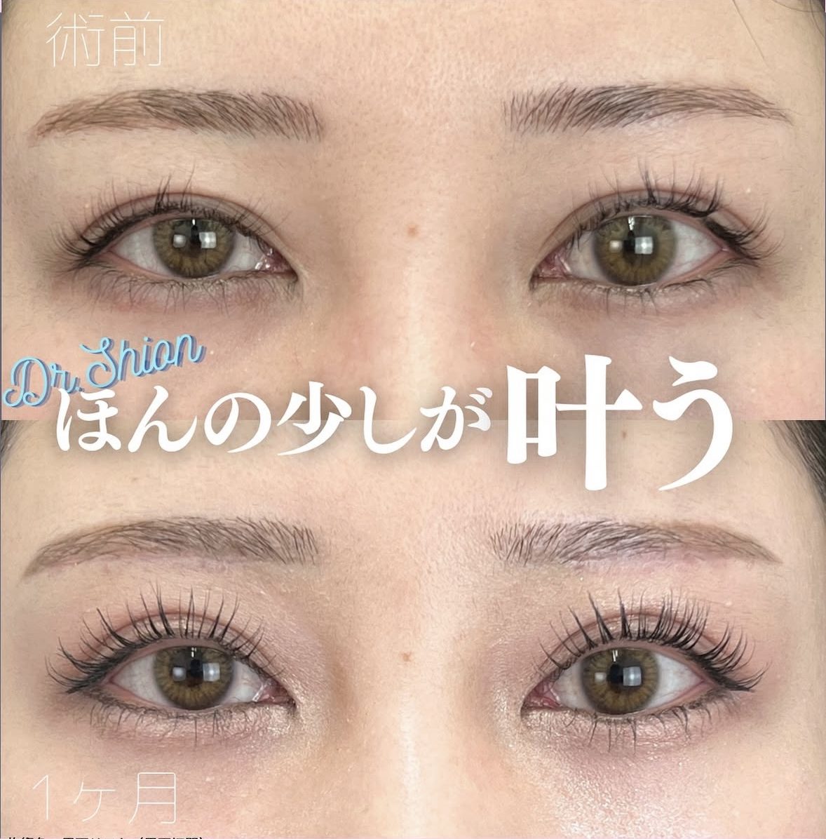 眉下リフト（眉下切開）