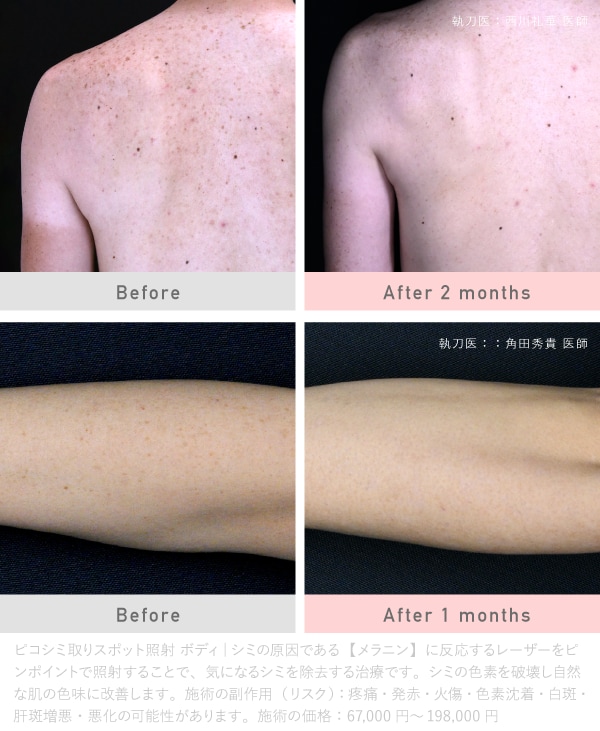 高槻でシミ取り・美白治療が安いおすすめ皮膚科｜湘南美容クリニック