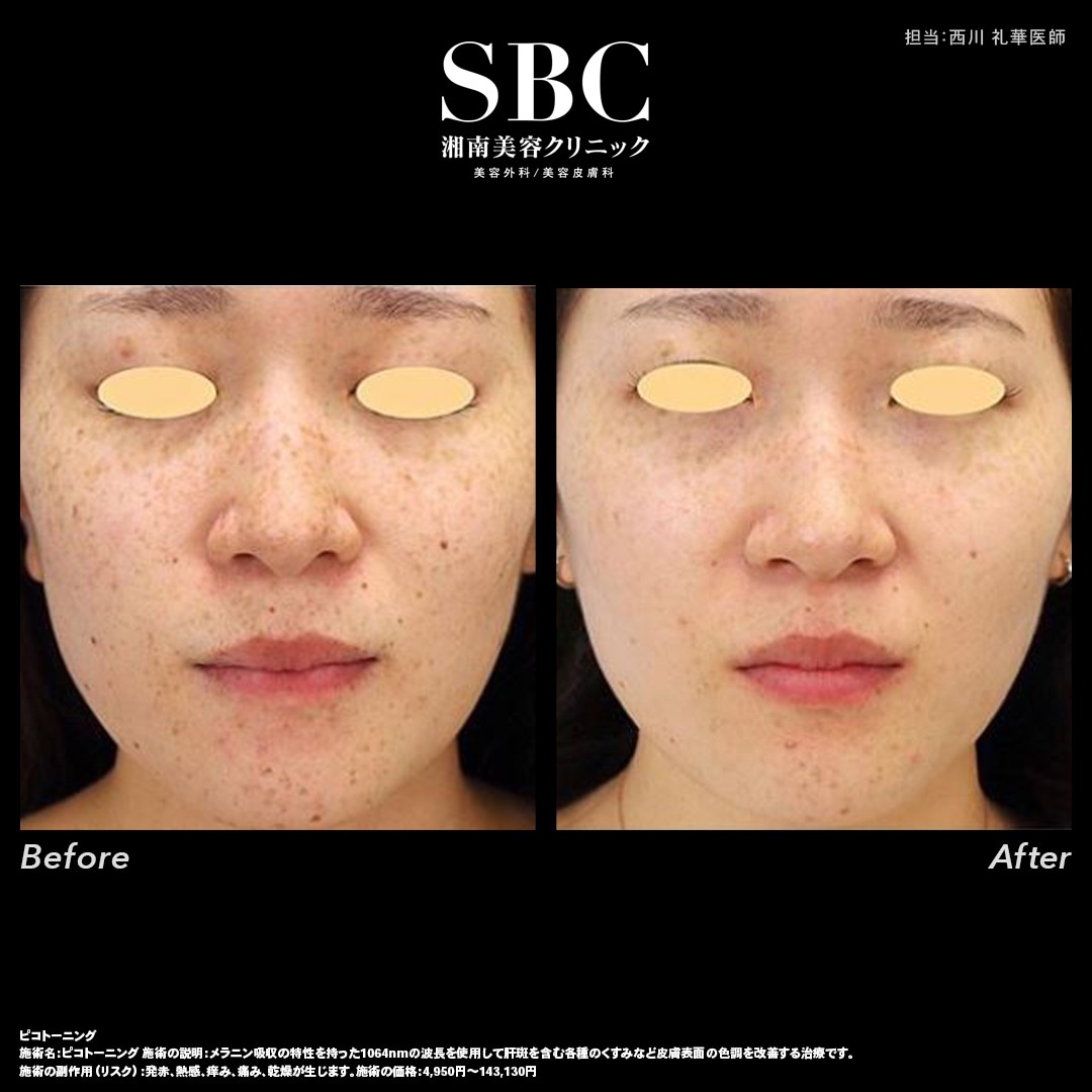 《シミが取れる仕組み》