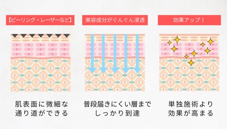 なぜ“組み合わせ治療”が効果的なのか？<br />
肌に穴を開けたら栄養を入れる「ゴールデンタイム」
