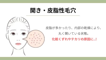 タイプ②：ファンデが落ちる「開き・皮脂性毛穴」