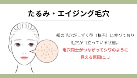 タイプ③：年齢とともに伸びる「たるみ・エイジング毛穴」