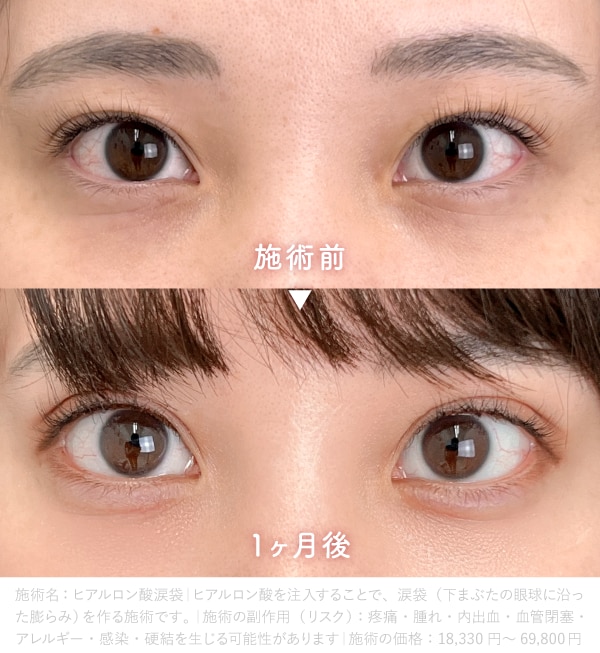 【セット術】<br />
二重整形×涙袋ヒアルロン酸注入