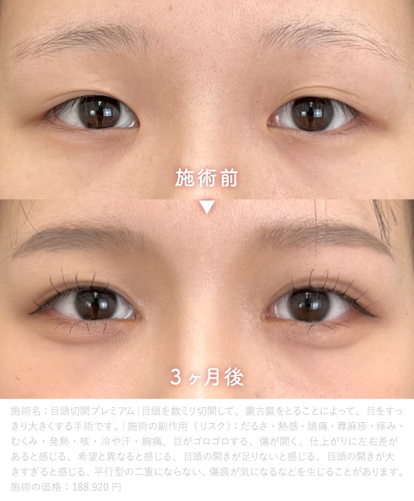 【セット術】<br />
二重整形×目頭切開プレミアム