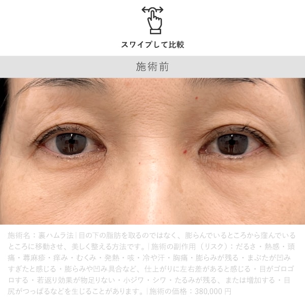 裏ハムラ 施術前