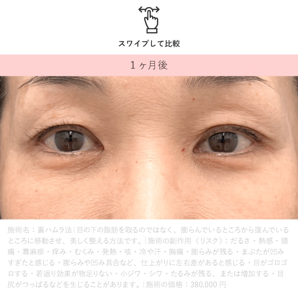 裏ハムラ 術後1ヶ月