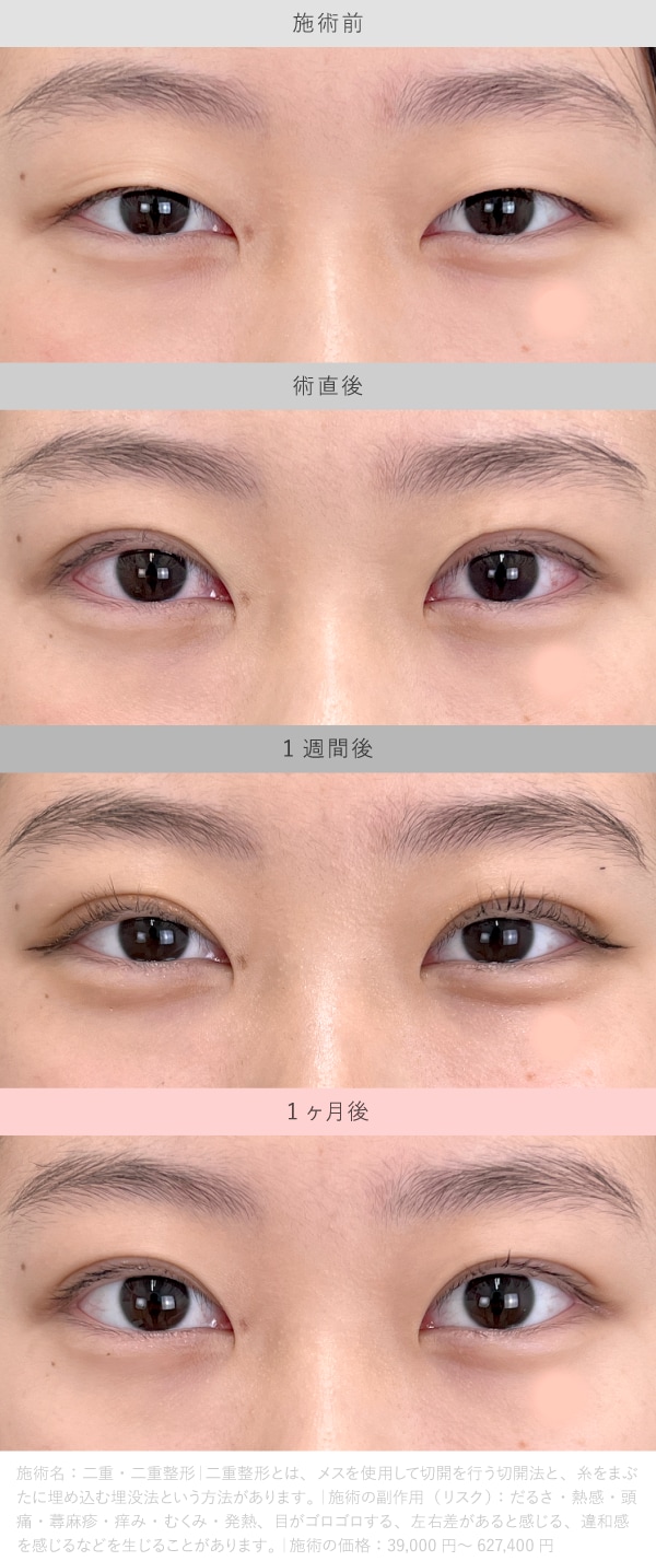 ダウンタイムの経過（クイックコスメティーク法の場合）