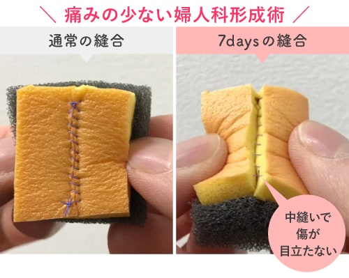 「抜糸なし（7days法）」で<br />
痛みと通院負担を軽減
