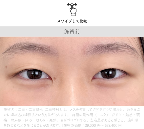 目の開きが改善された症例の施術前