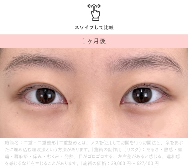 目の開きが改善された症例の1ヶ月後