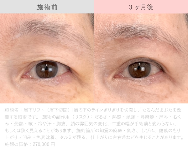 しおん先生の眉下リフト症例写真