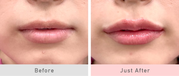 「唇のヒアルロン酸」注入で、<br />
ぷっくりとした魅力的な口元へ
