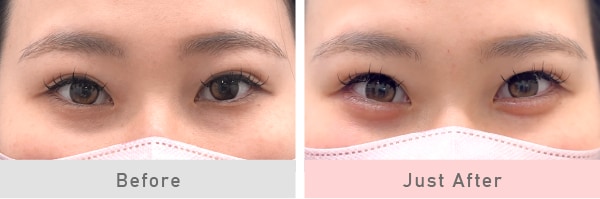 「涙袋ヒアルロン酸」で、<br />
立体的で愛らしい目元へ