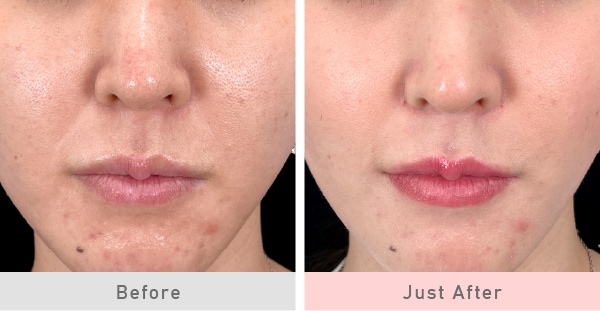 高槻院で人気のヒアルロン酸注入<br />
「貴族フィラー」でほうれい線ケア