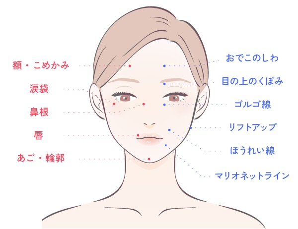 ヒアルロン酸が注入できる主な部位
