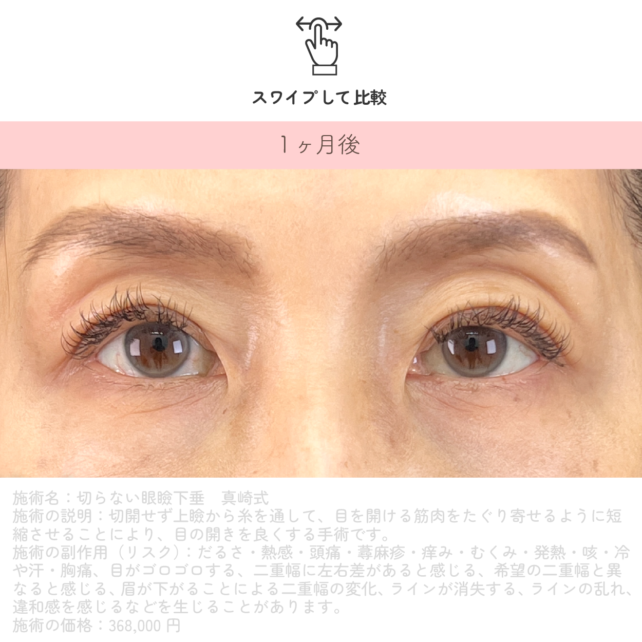切らない眼瞼下垂 真崎式 術後1ヶ月