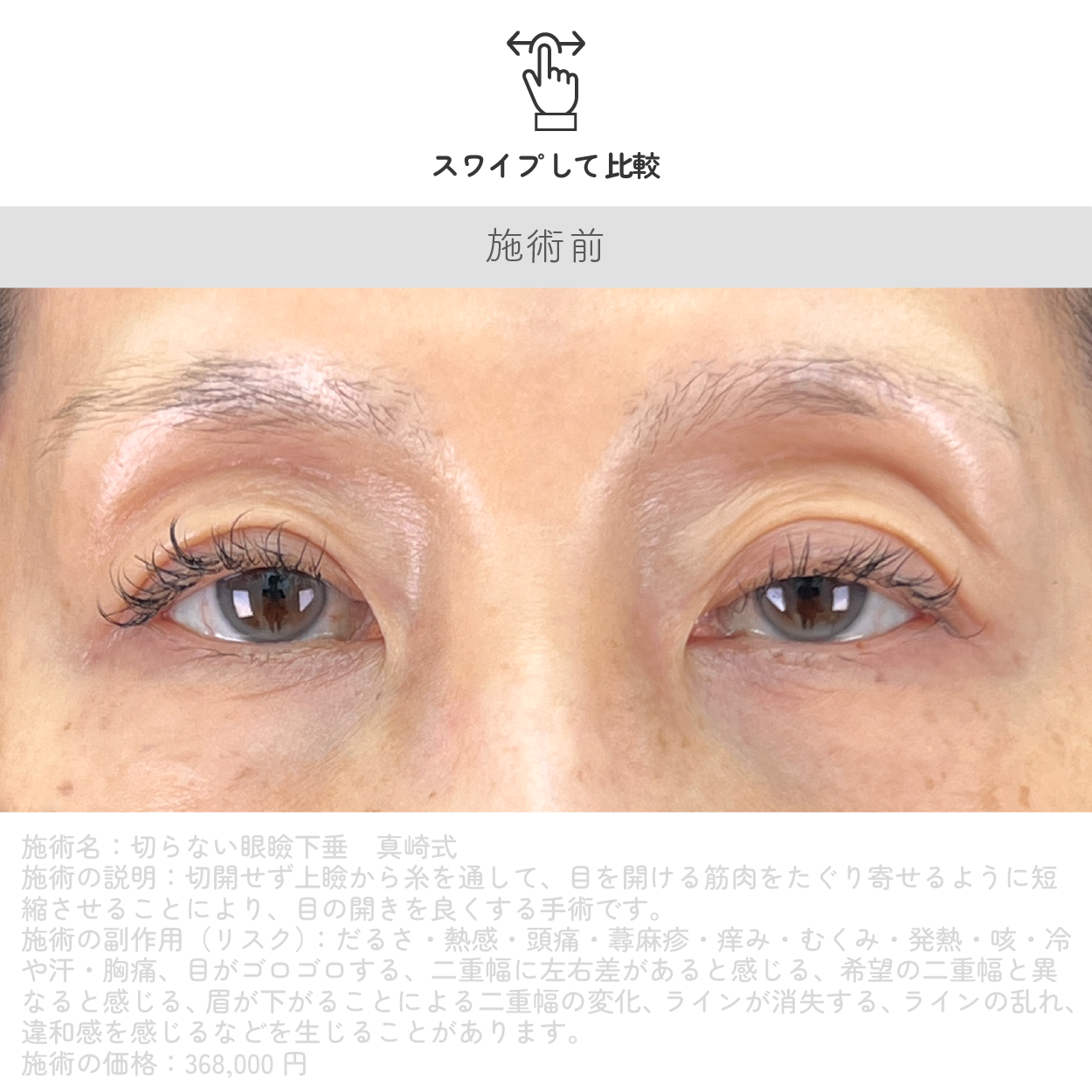 切らない眼瞼下垂 真崎式 施術前
