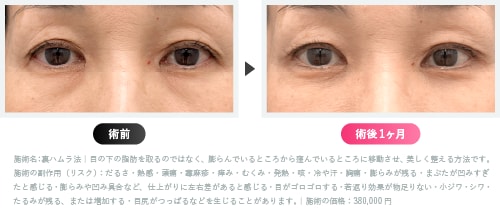 脂肪注入をしたくない方へ「裏ハムラ法」のご提案