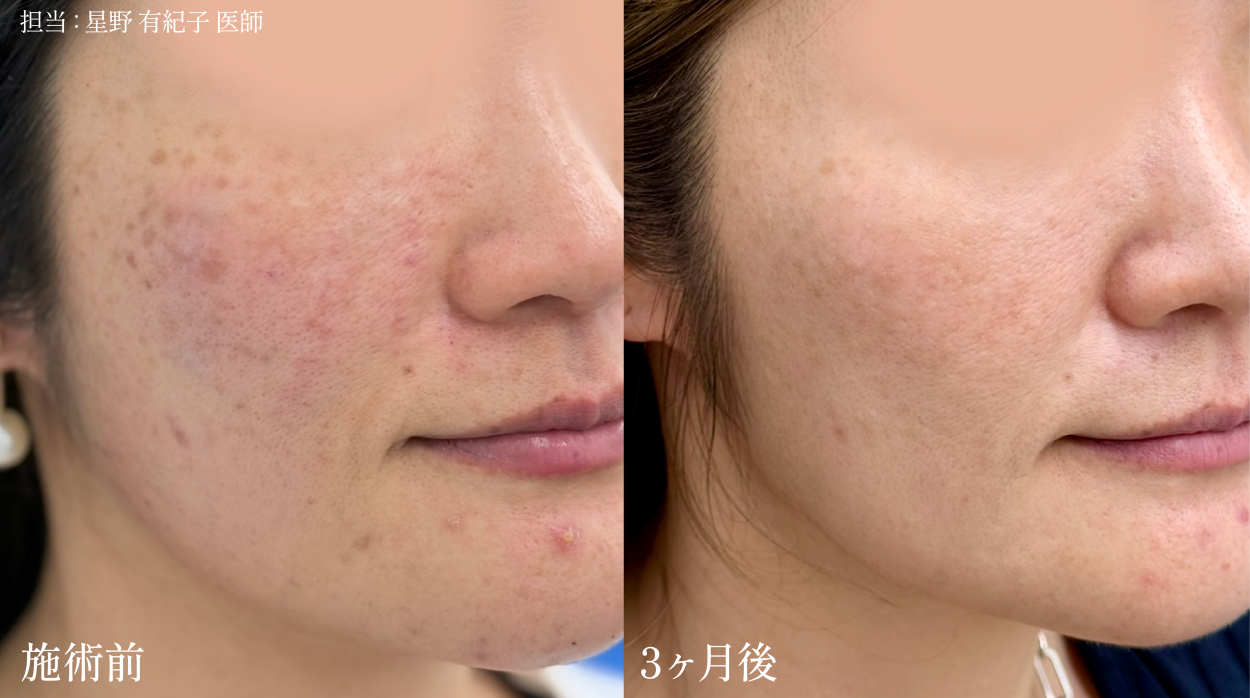 乾燥による赤み・肌荒れの改善