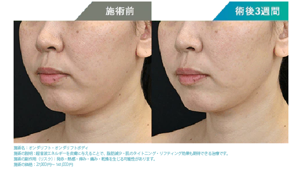  オンダリフトは「脂肪を破壊して減らす」治療
