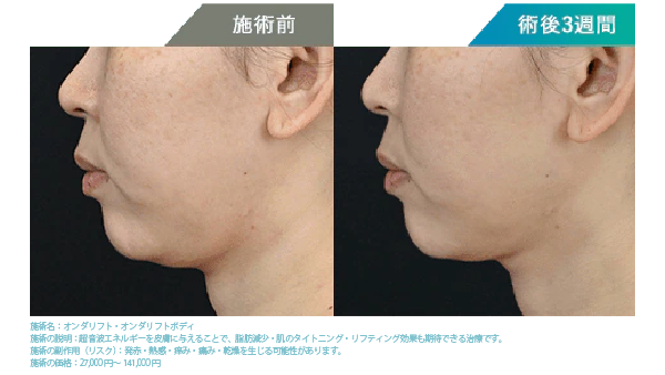  1回でも小顔効果を感じられますか？