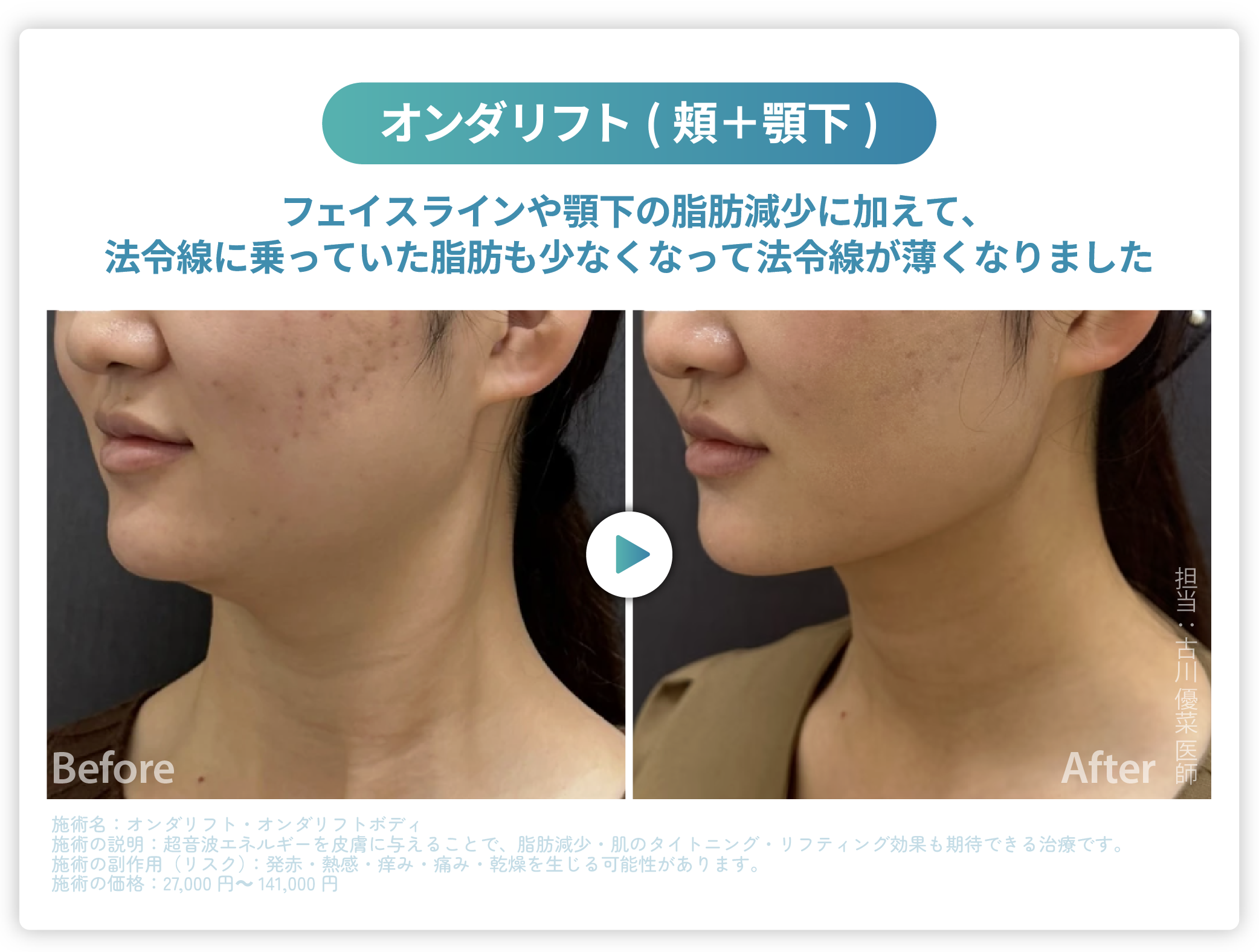 大阪・高槻】オンダリフトが遂にSBC高槻院に登場！韓国で人気の痩身