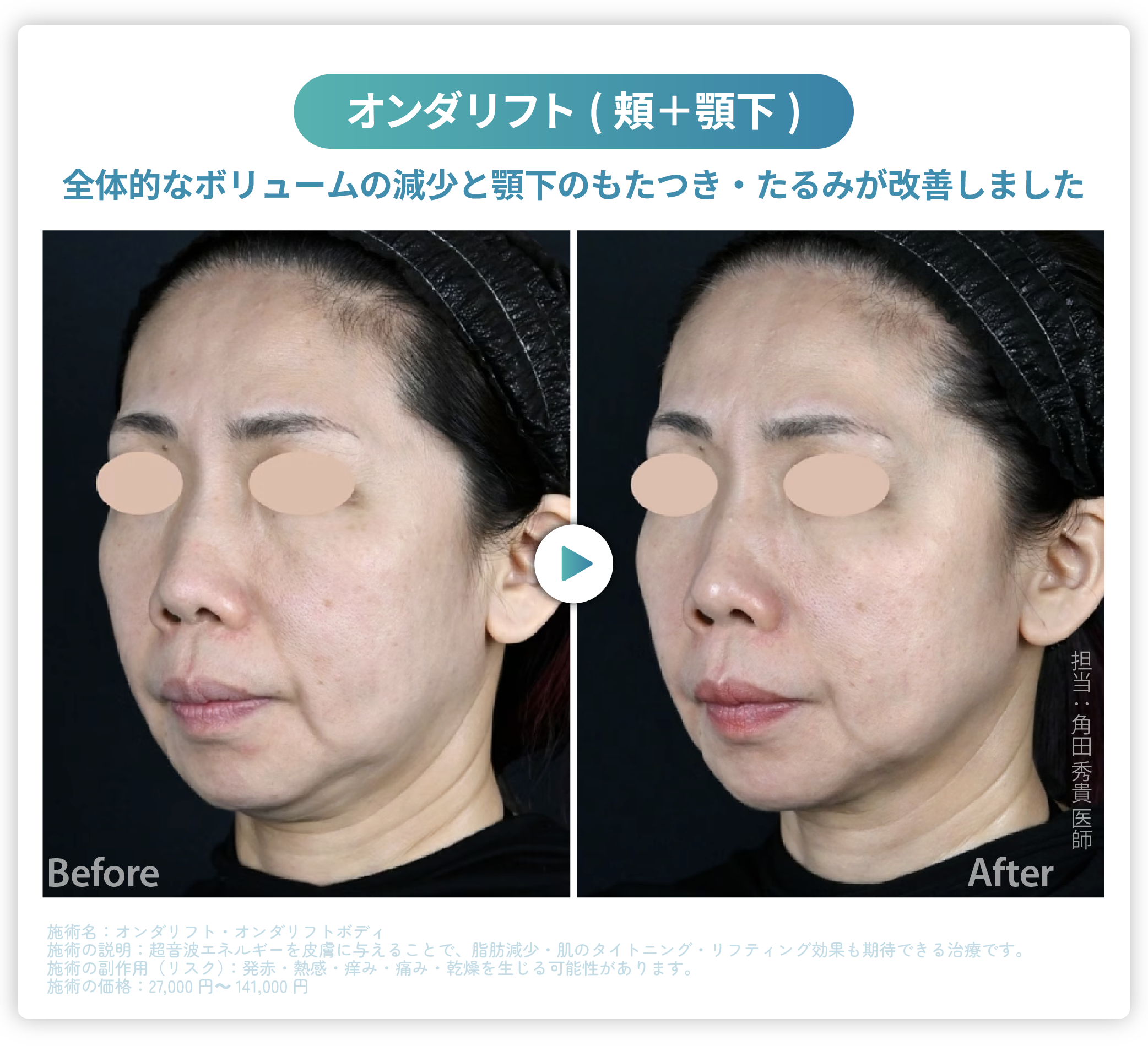大阪・高槻】オンダリフトが遂にSBC高槻院に登場！韓国で人気の痩身