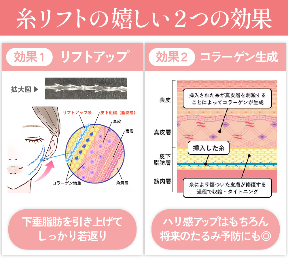 糸リフトが人気の理由や仕組み