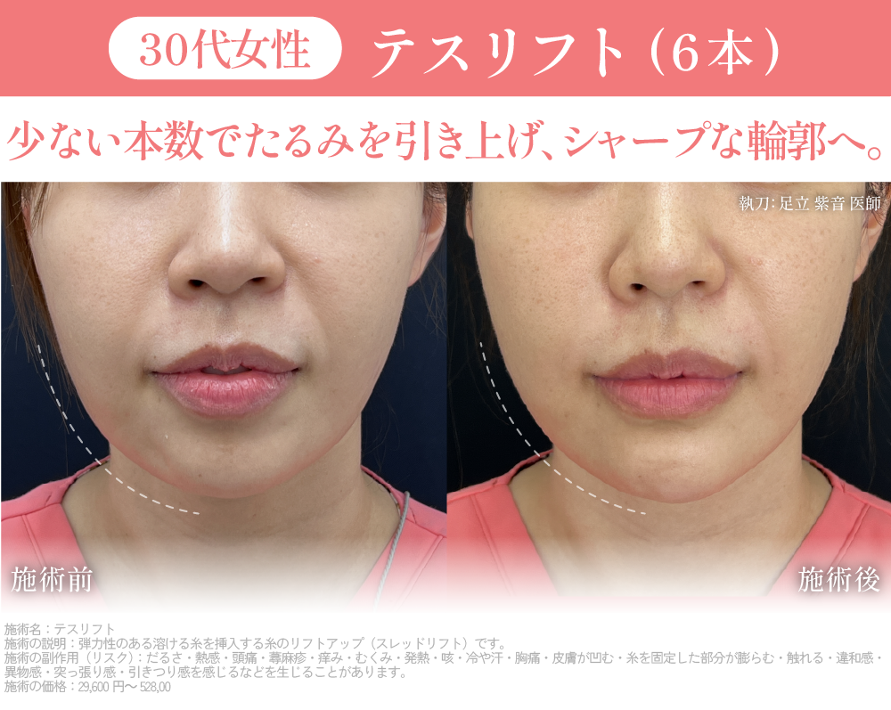 2. 最小限の本数でしっかり変化も出す「高効率リフト」