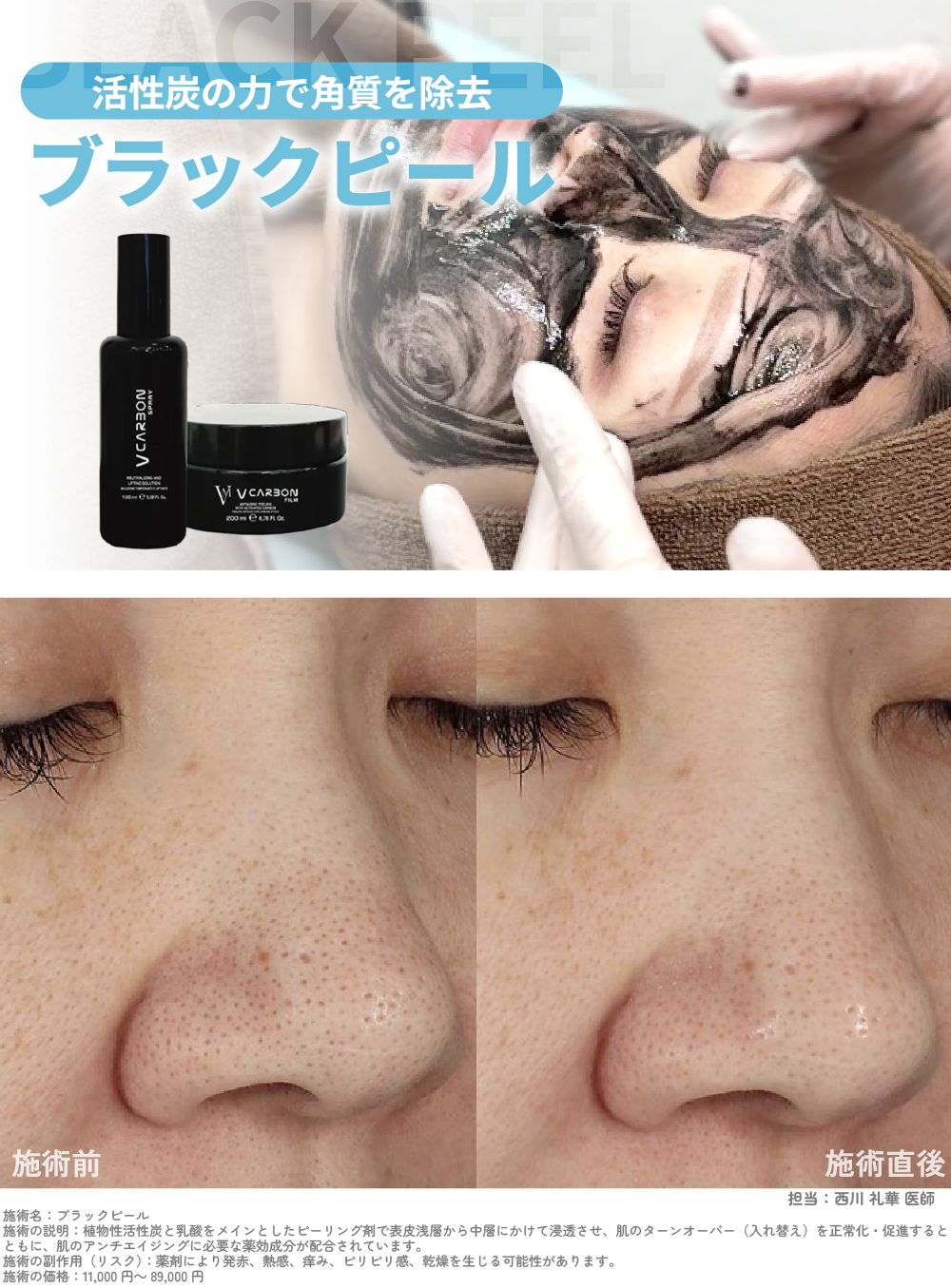 肌のごわつき・くすみが気になる方に【ブラックピール】