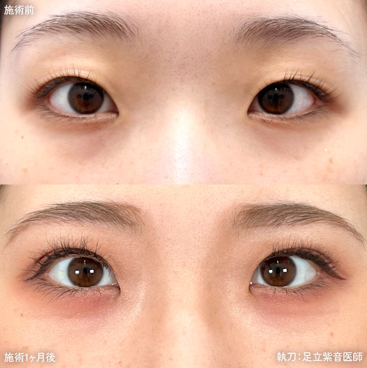 週末二重術症例