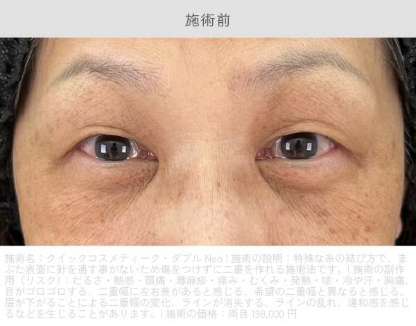 切らない眼瞼下垂 真崎式 施術前
