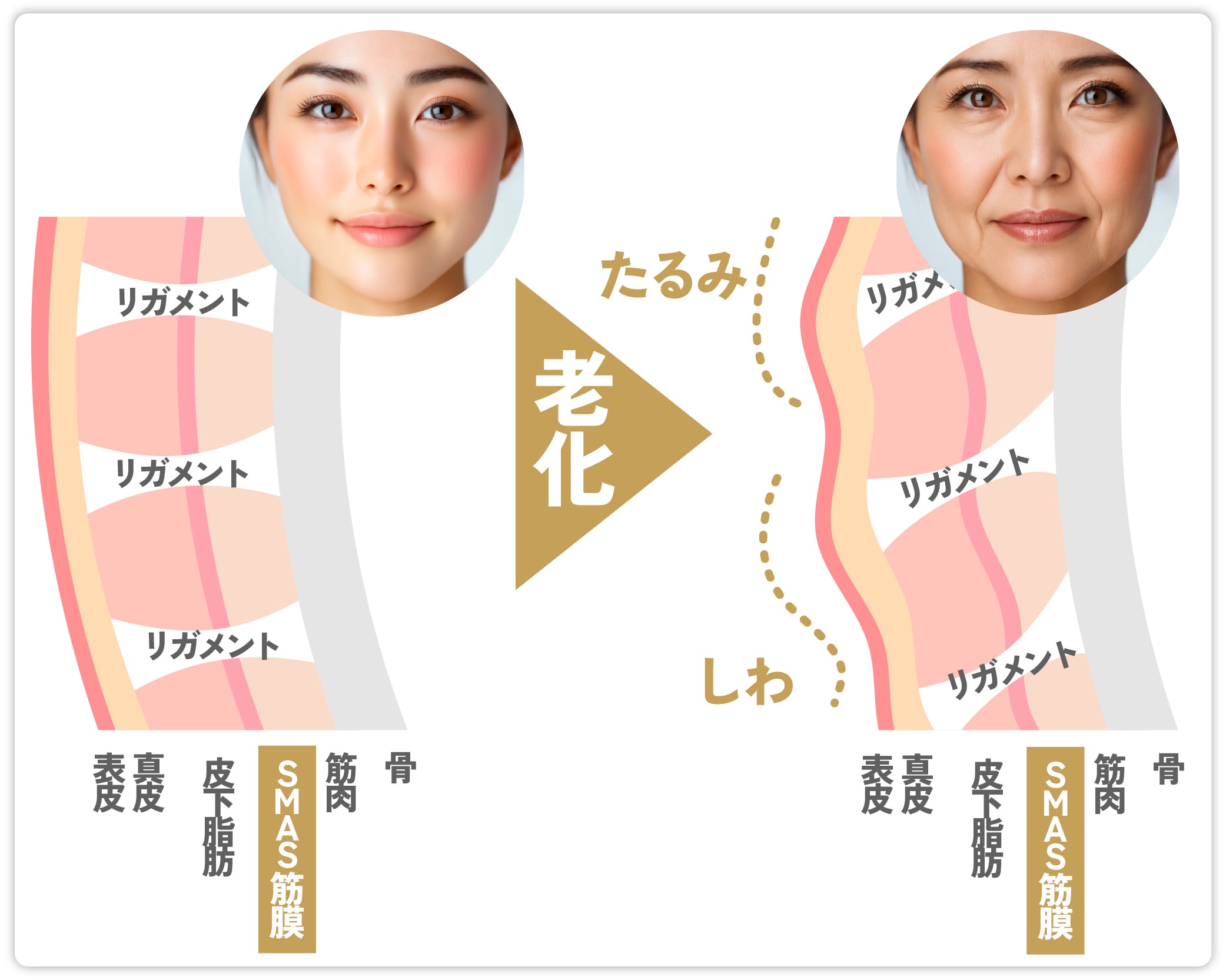 たるみの原因はSMAS筋膜のゆるみ