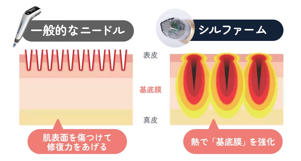 シルファーム(RF)の熱で基底膜を強化