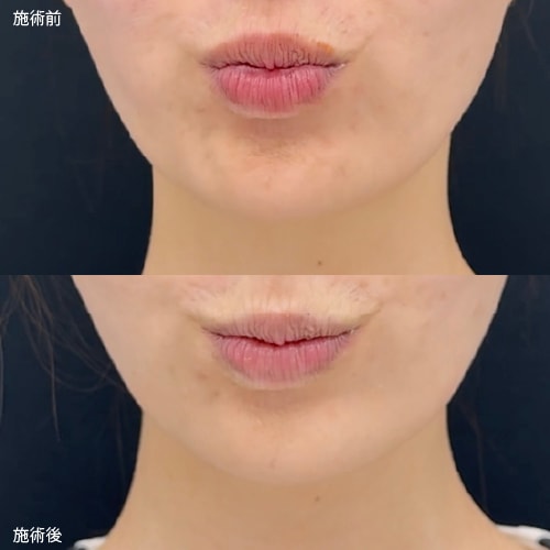 高槻院のあごのボトックス