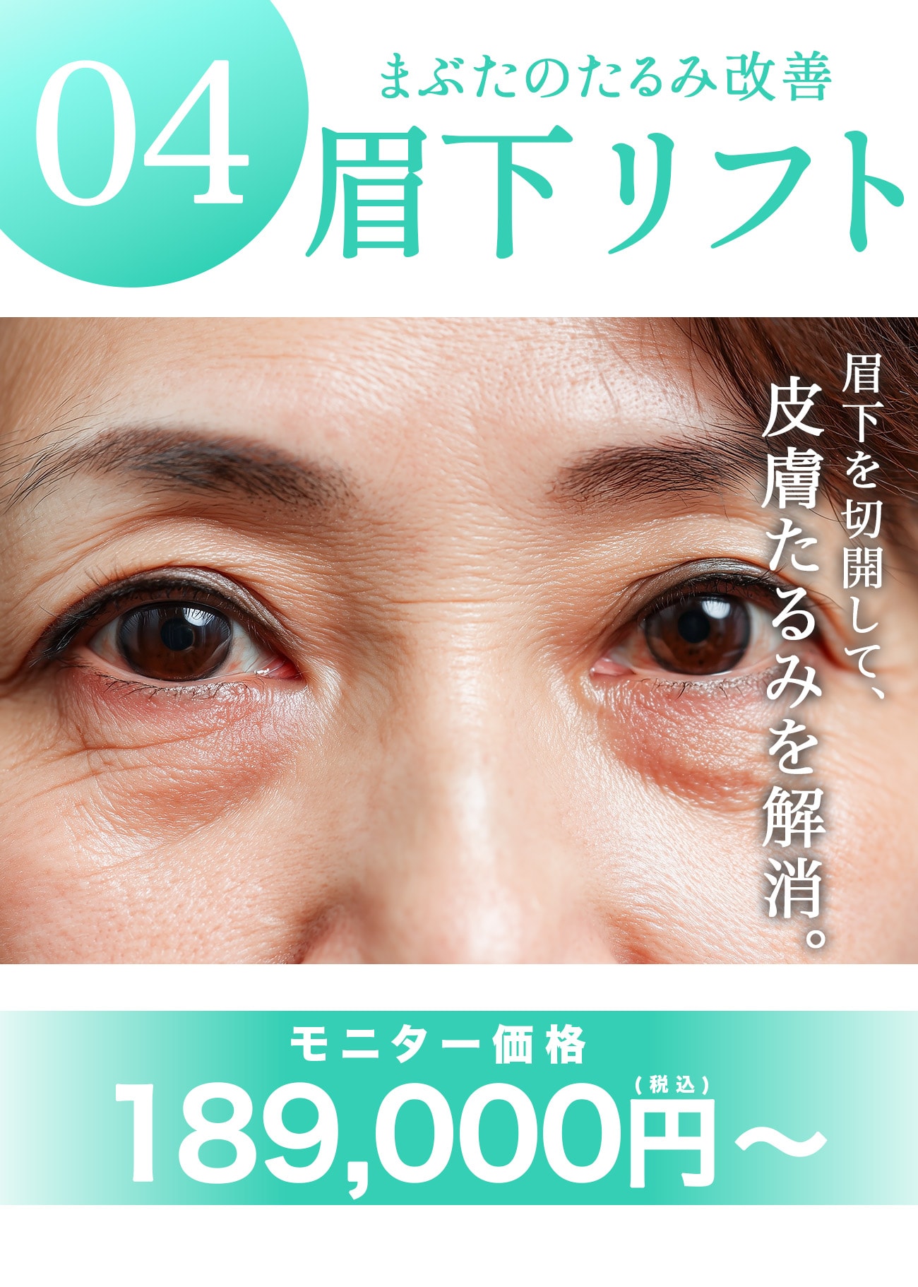 【眉下リフト】眼瞼下垂・たるみ目解消