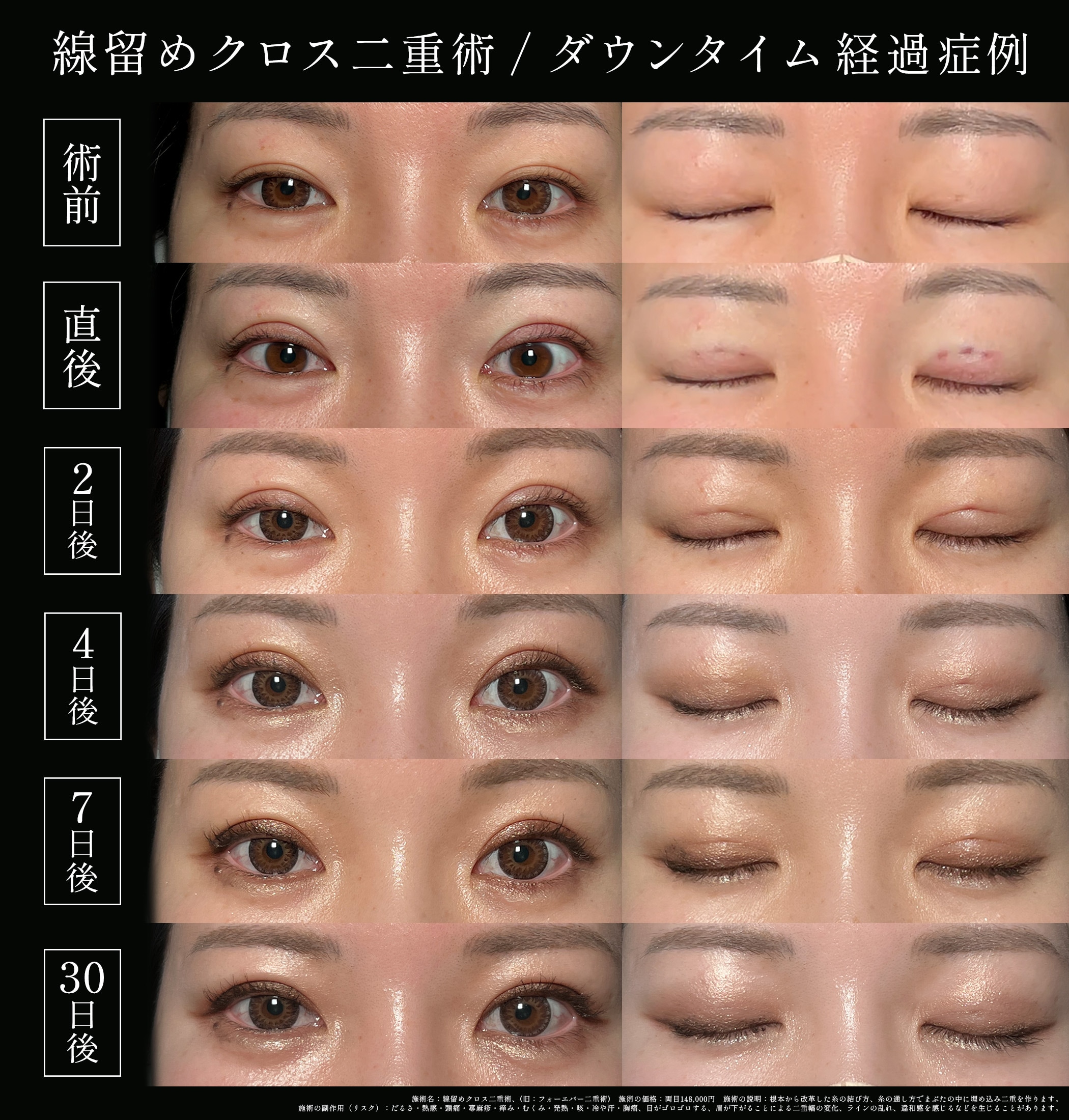 30代女性の線留めクロス二重術(旧フォーエバー二重術)症例