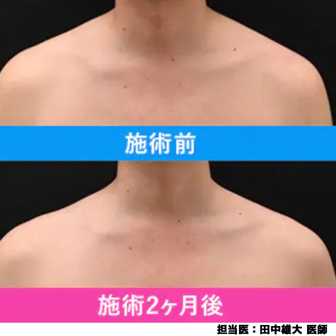 肩の筋肉にボトックスを注射することで、<br />
肩のラインをなだらかに整えたり、肩こりを和らげる施術