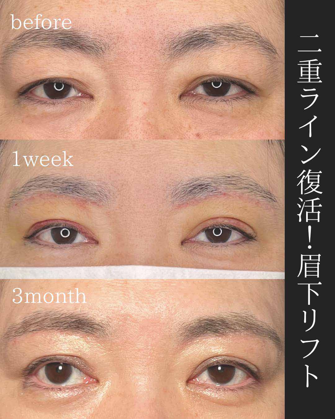 眉下リフト症例
