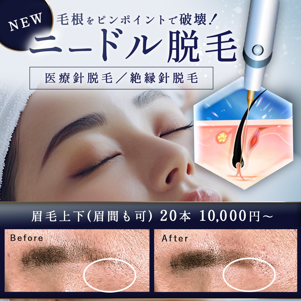 【新治療導入！】毛根を破壊して永久脱毛。話題のニードル脱毛開始しました！_埼玉県で針脱毛するなら湘南美容クリニック所沢院