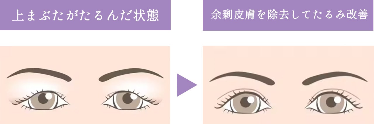 眉下リフトって実際どんな治療？