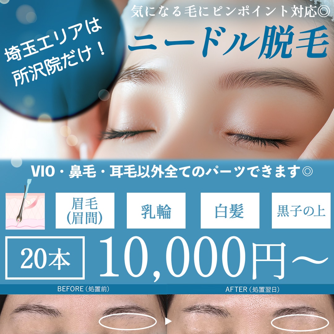 【埼玉エリア唯一の取り扱い】毛根を破壊して永久脱毛。話題のニードル脱毛開始しました！_埼玉県で針脱毛するなら湘南美容クリニック所沢院