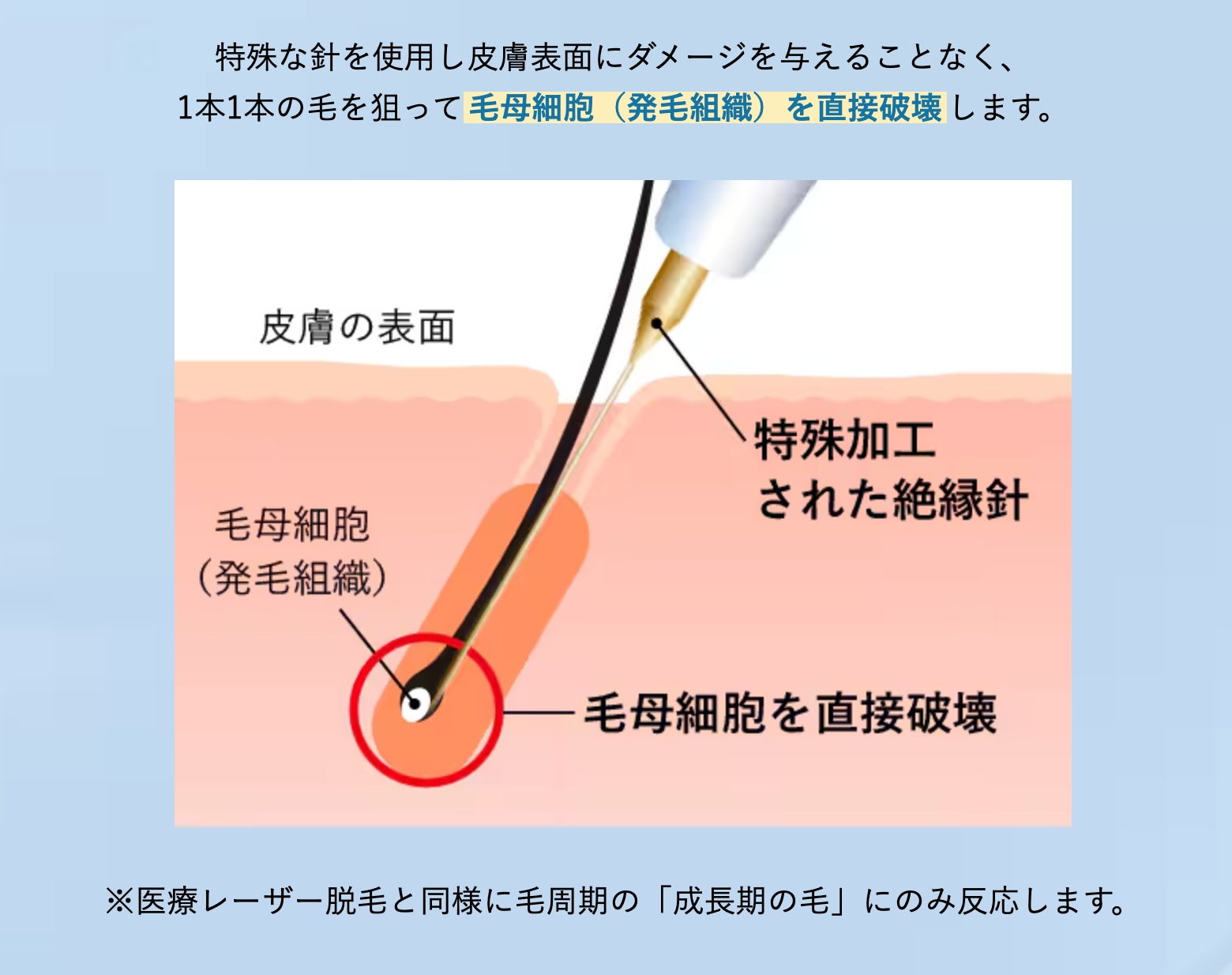 毛根を直接破壊するピンポイントの永久脱毛