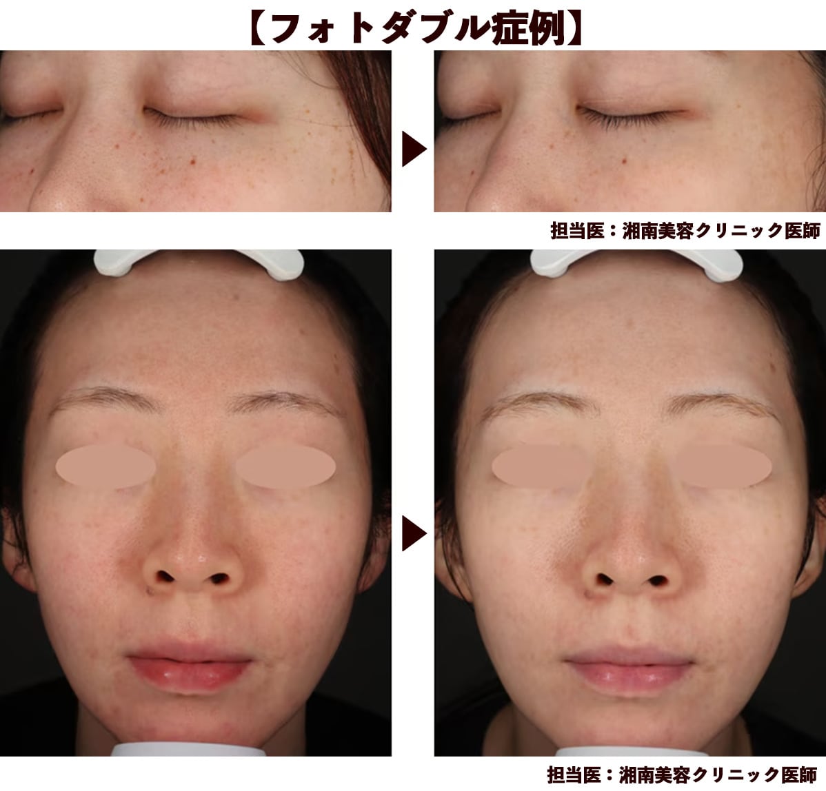 フォトダブル症例紹介